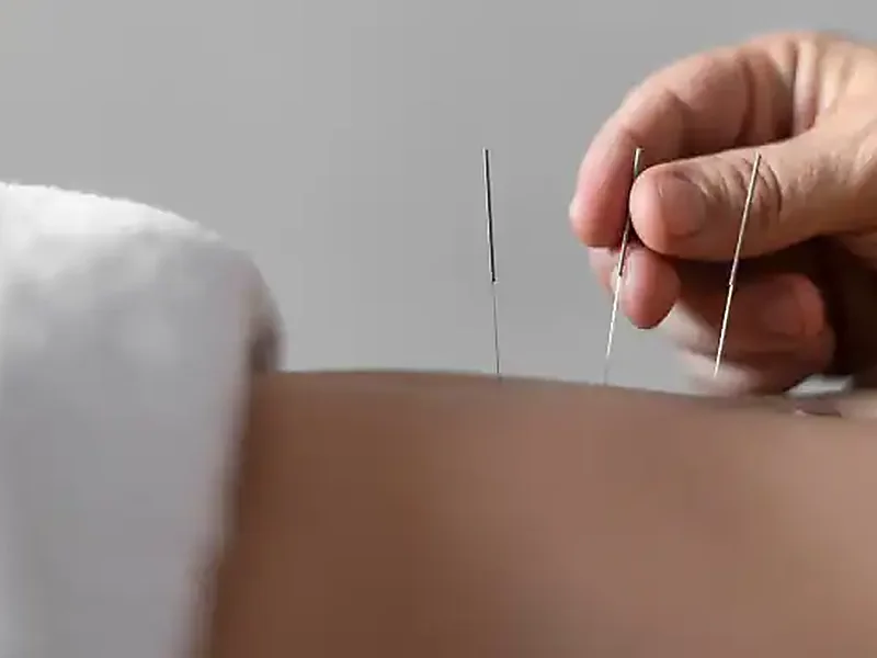 Close-up of dry needling being performed