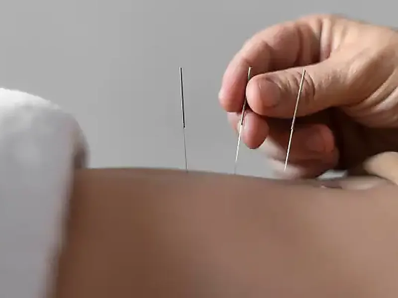 Close-up of hands-on needle treatment