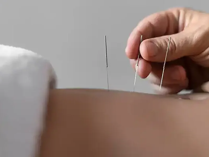 Close-up of dry needling being performed on a patient
