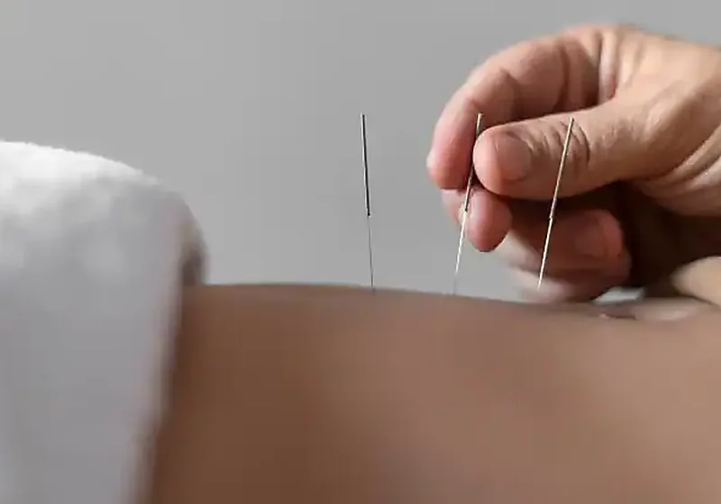 Clinician performing dry needling trigger-point treatment