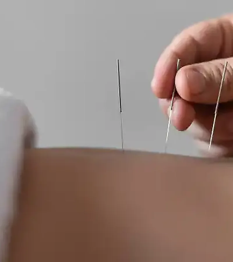 Clinician performing dry needling on a patient